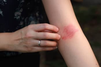 Mengenal Psoriasis Vulgaris, Penyakit Kulit yang Jarang Diketahui