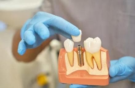 Bagaimana Perawatan Saluran Akar Gigi dengan BPJS? Begini Prosedurnya