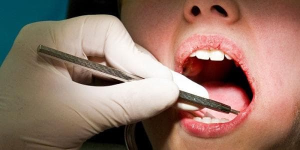 Apakah Operasi Gigi Bungsu Ditanggung BPJS? Begini Penjelasannya 