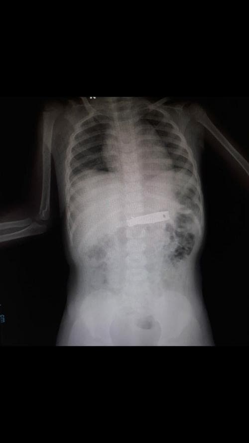 Simak Kisaran Biaya Rontgen Tulang Belakang