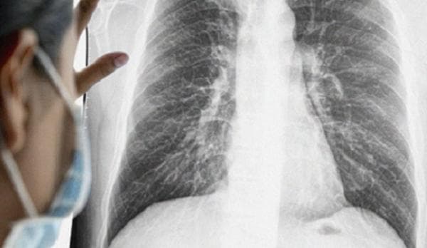 Cek Biaya Rontgen Paru di Puskesmas, segini Kisarannya