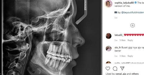 Simak Kisaran Biaya Rontgen Gigi di Puskesmas