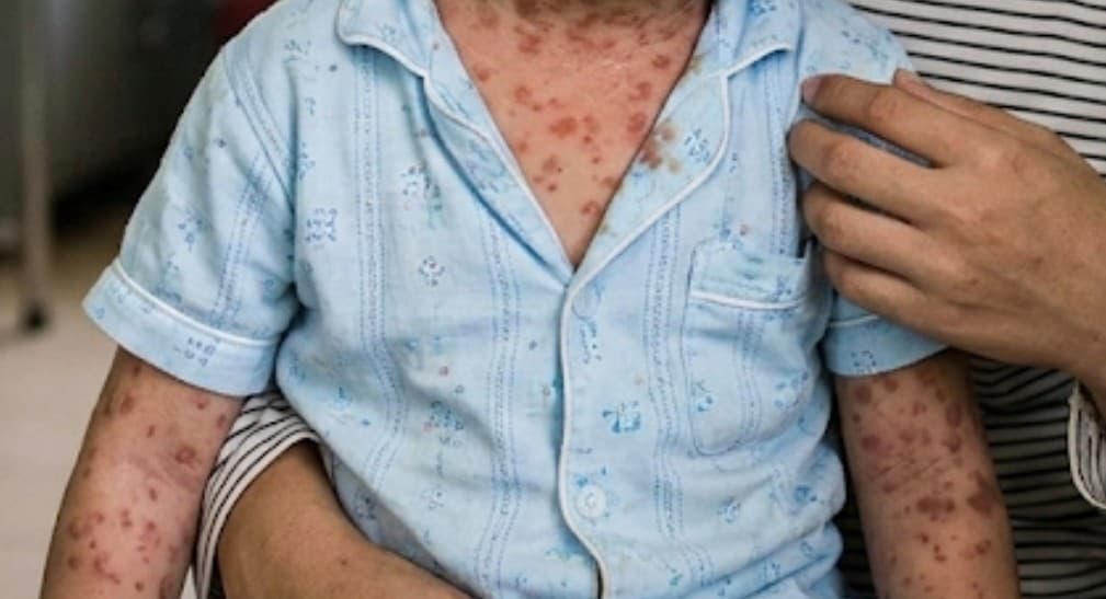 Waspada Campak, Kemenkes Catat 63.769 Suspek di 2025 dan 21 Kejadian Luar Biasa Awal 2026 Waspada Campak, Kemenkes Catat 63.769 Suspek di 2025 dan 21 Kejadian Luar Biasa Awal 2026