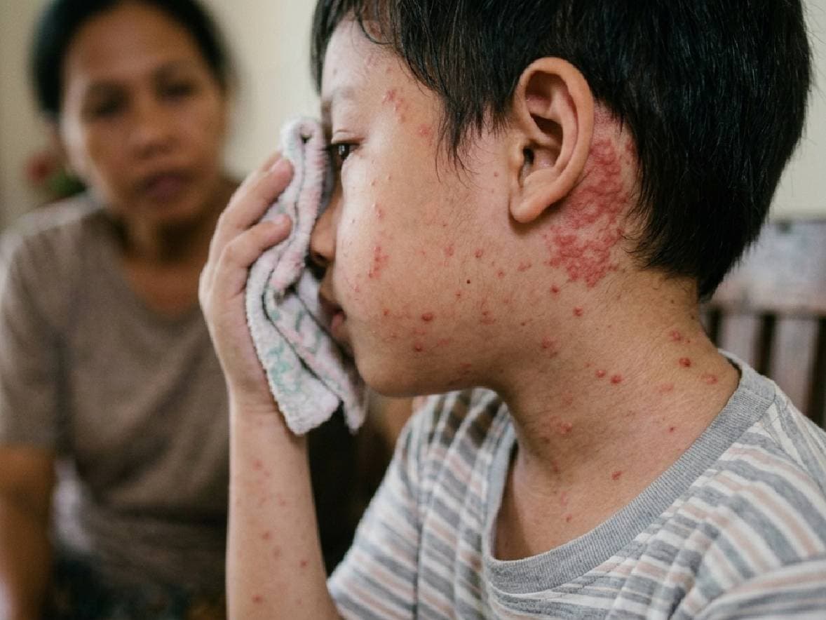 5 Tanda Campak pada Anak Wajib Diwaspadai Orang Tua, Ini yang Terlihat