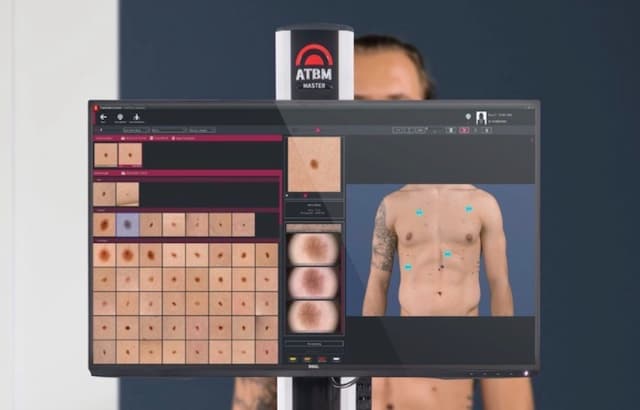 Ancaman Sinar UV, Teknologi AI Bisa Deteksi Dini Kanker Kulit