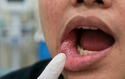 Kasus Campak Turun 93 Persen, Kemenkes Pastikan Pengawasan Tetap Ketat