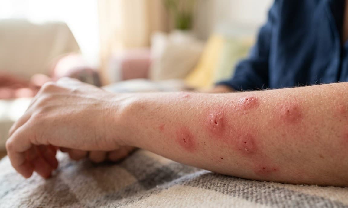 Bentol-Bentol Disertai Sesak Napas? Waspada Syok Anafilaktik Bisa Berakibat Fatal