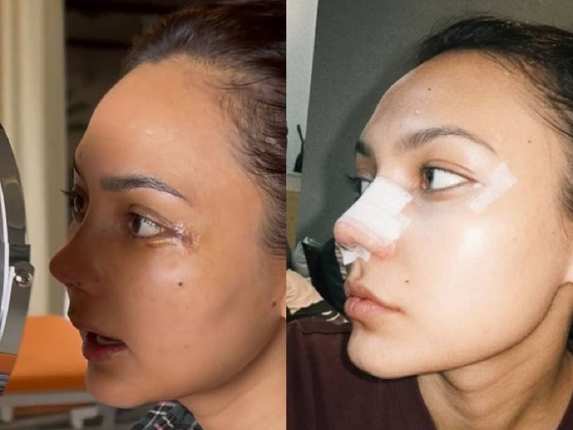Rina Nose Ganti Nama usai Oplas Hidung? Ini Faktanya!