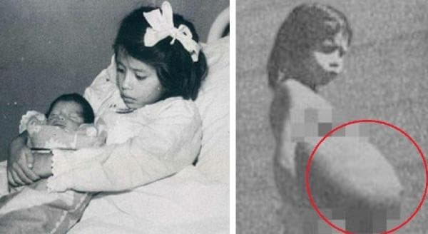 Kisah Pilu Lina Medina Jadi Ibu Termuda, Melahirkan di Usia 5 Tahun