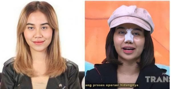 Ketagihan! Usai Oplas Hidung, Mayang Mengaku Akan Lakukan Oplas di Bagian Ini Ketagihan! Usai Oplas Hidung, Mayang Mengaku Akan Lakukan Oplas di Bagian Ini