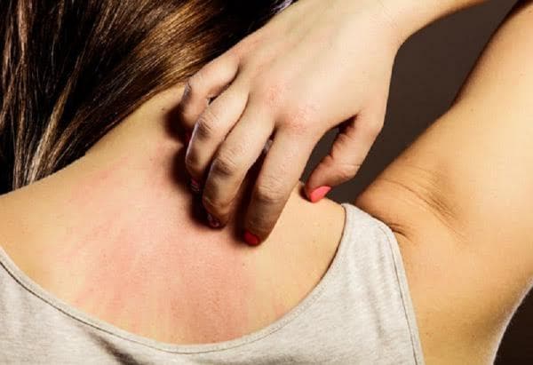 5 Rekomendasi Salep Alergi Dapat Dipakai Untuk Redakan Gatal