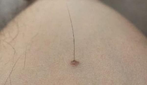 Kenapa Tahi Lalat yang Ditumbuhi Rambut Berbahaya? Ini Penjelasan Secara Medis