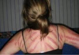 Waspada! Bahaya Langsung Kerokan saat Nyeri Dada, Simak Selengkapnya