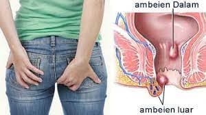 Mudah dan Aman! Cara Praktis Menghilangkan Benjolan Ambeien, Cukup Pakai Es Batu