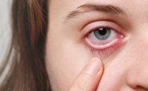 Simak 8 Penyebab Sakit Mata Merah Sebelah