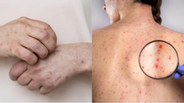 Kenali Penyebab dan Gejala dari Penyakit Sifilis