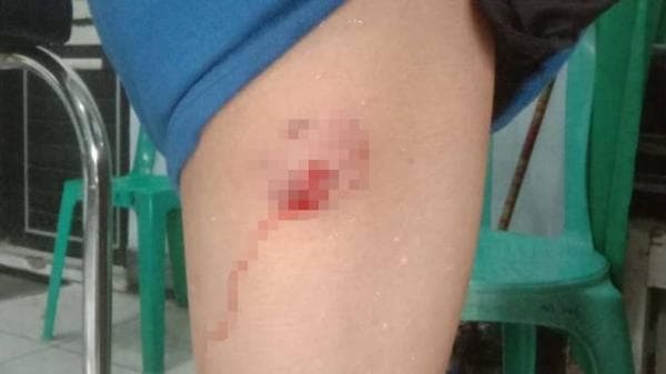 Digigit Anjing Rabies 1 Tewas 20 Warga Timor Tengah Selatan NTT Terjangkit Rabies