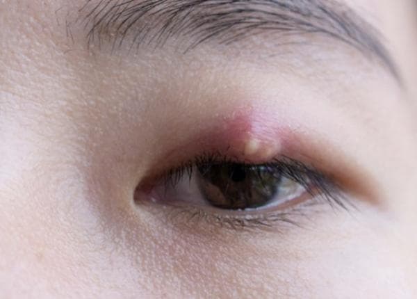 Merasa Tidak Nyaman dan Minder, 4 Obat Mata Bintitan yang Tersedia di Apotik Merasa Tidak Nyaman dan Minder, 4 Obat Mata Bintitan yang Tersedia di Apotik