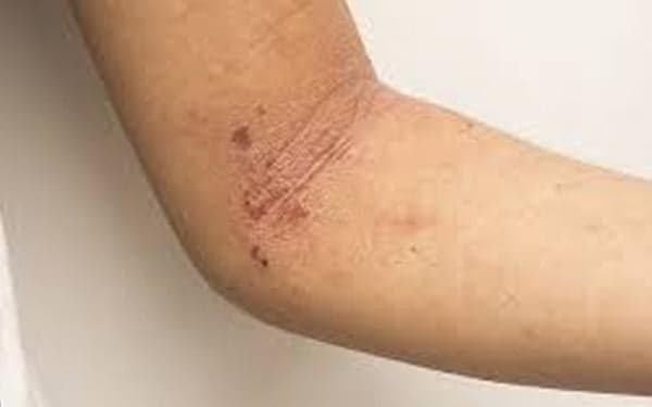 Inilah 4 Cara Mencegah Iritasi Kulit pada Lipatan Tubuh, Agar Tak Memperburuk Masalah Kulit