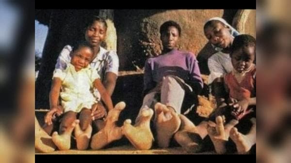 Miliki Sejarah Inces, Inilah Kisah Unik Suku Vadoma di Zimbabwe yang Punya Kaki Mirip Burung Unta Miliki Sejarah Inces, Inilah Kisah Unik Suku Vadoma di Zimbabwe yang Punya Kaki Mirip Burung Unta