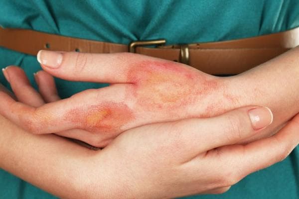 Penanganan Luka Bakar Sesuai Tingkat Keparahannya