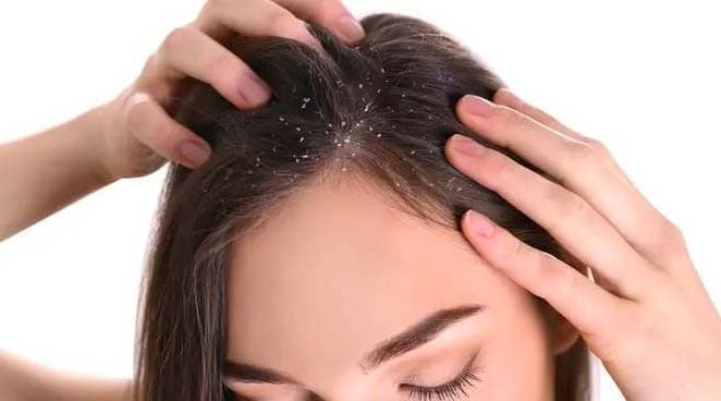 Bukan Digaruk, Begini Cara Mengatasi Ketombe yang Membandel