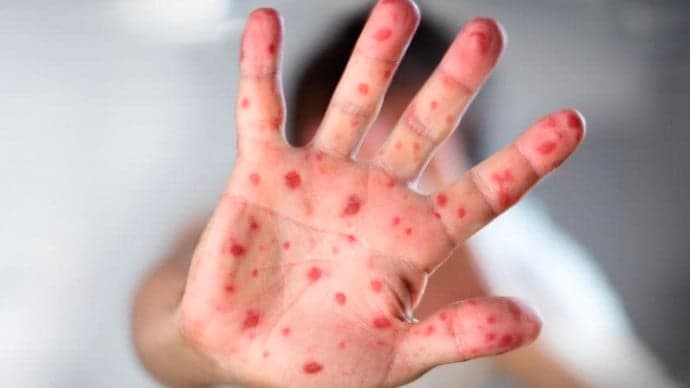 Kasus Cacar Monyet Tembus 62 Pasien, Kemenkes Sebut Didominasi dari Jakarta