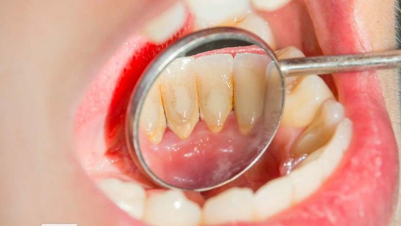 5 Cara Memutihkan Gigi Kuning yang Membandel, Tak Perlu ke Dokter Bisa di Rumah Saja