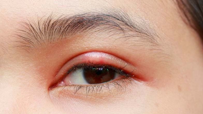 Inilah Penyebab Mata Bintitan yang Perlu Diwaspadai dan Cara Mengatasinya