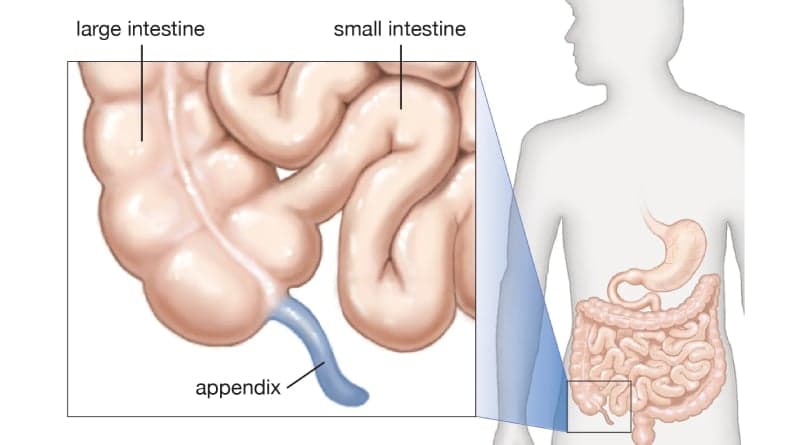 7 Ciri-ciri Awal Usus Buntu, Waspadai Gejala Berikut Ini!