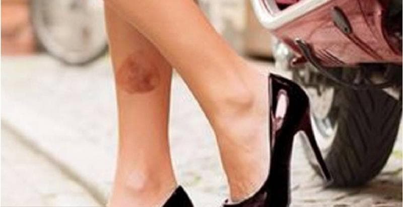 Catat! Ini Cara Mengatasi Luka Kena Knalpot, Jangan Sembarangan Oles Odol atau Minyak