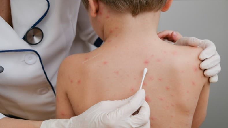 Ini 5 Cara Mengobati Cacar Air agar Cepat Kering dan Hilang