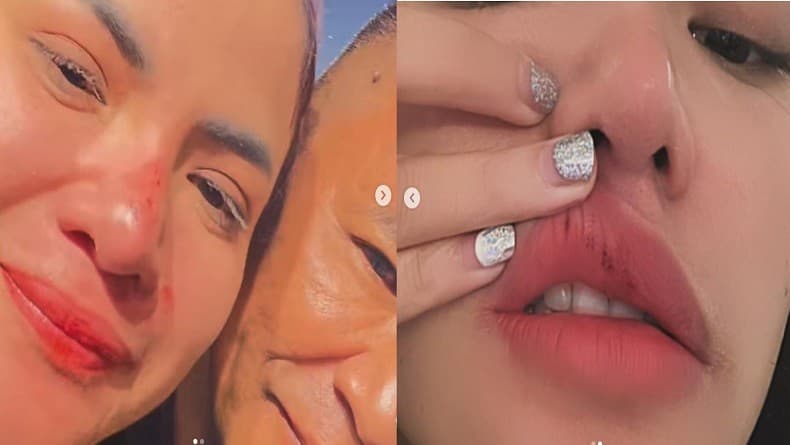 Kalahkan Berlliana Lovell saat Duel Tinju, Begini Kondisi Wajah Dinar Candy Sekarang