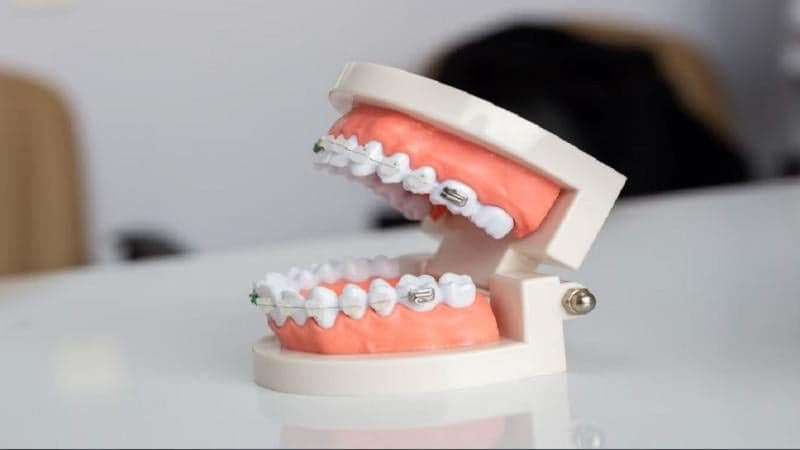 Lakukan Diet Cair Setelah Memasang Behel Gigi!