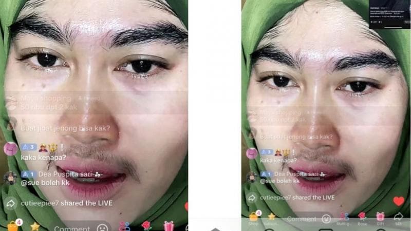 Viral Wajah Seorang Wanita Muncul Bulu Lebat di Wajah usai Pakai Skincare