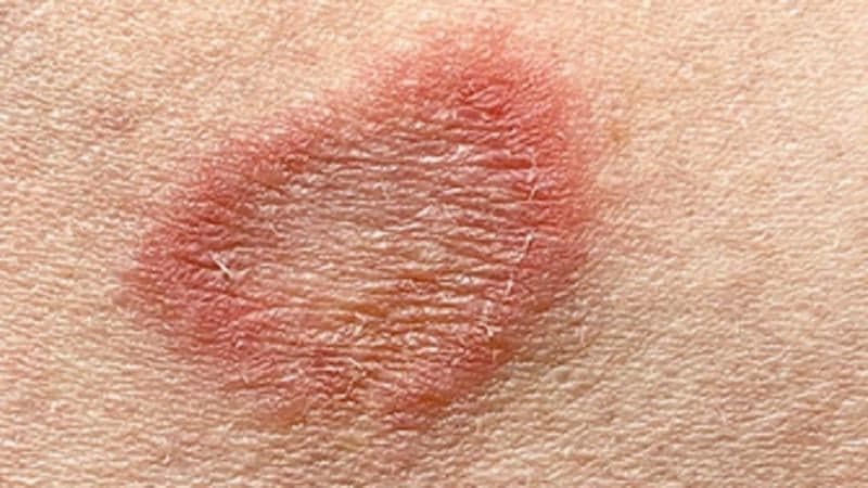 Apa Itu Ringworm? Penyakit Kulit yang Belakangan Viral di Kalangan Anak Gym