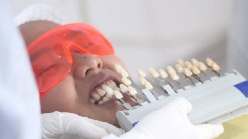 Tips Merawat Gigi Setelah Perawatan Bleaching