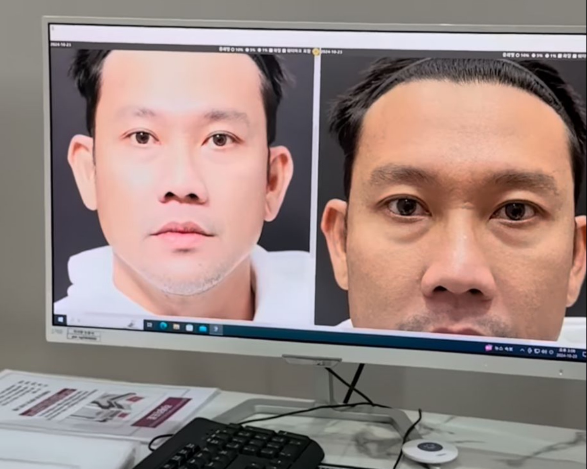 5 Potret Denny Sumargo Operasi Plastik Kantung Mata di Korea, <i>Loh</i> Kok Payudara Ikut Membesar?