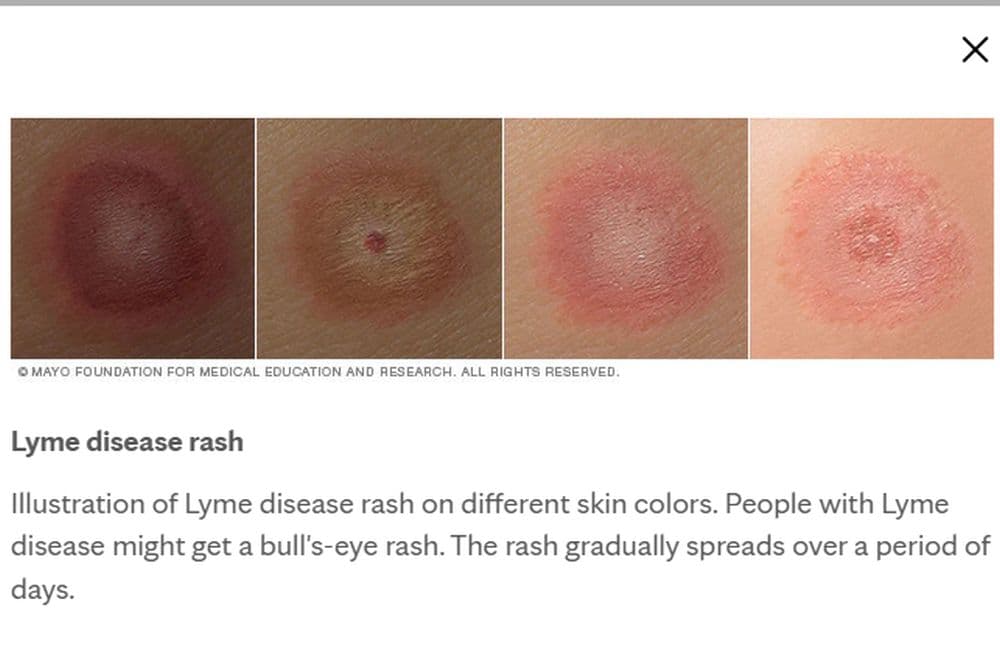 Penyebab dan Ciri Penyakit Lyme yang Menyerang Bella Hadid Sejak Usai 16 Tahun