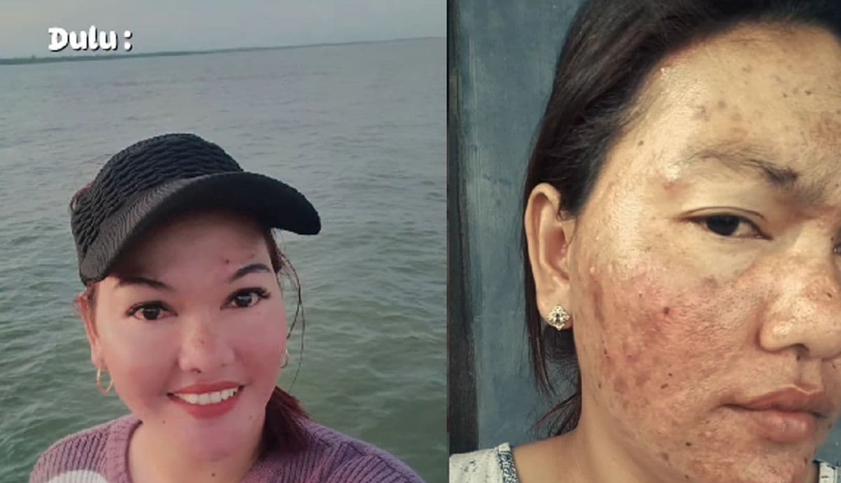 Viral Kisah Kecanduan Skincare Abal-Abal Selama 10 Tahun, Pengguna: Cantik Hanya di Awal
