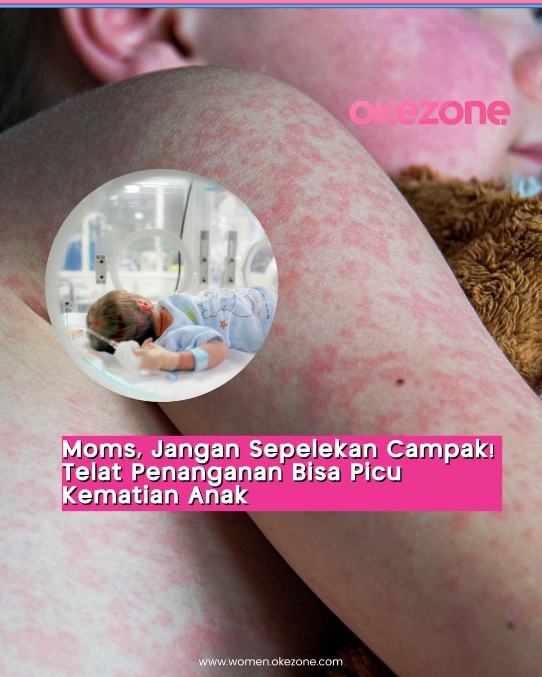 Kemenkes: Tingkat Penularan Penyakit Campak Sangat Tinggi