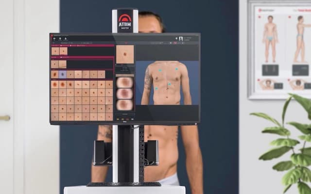 Deteksi Dini Kanker Kulit dengan TeknologiAI, Ini Kata Dokter!