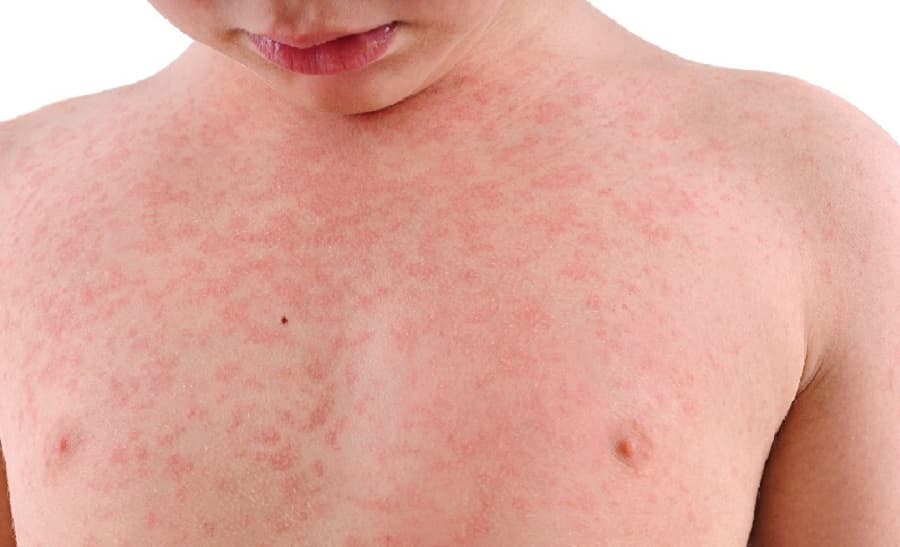 Kasus Campak Menurun 93, Kemenkes Pastikan Surveilans Tetap Ketat!