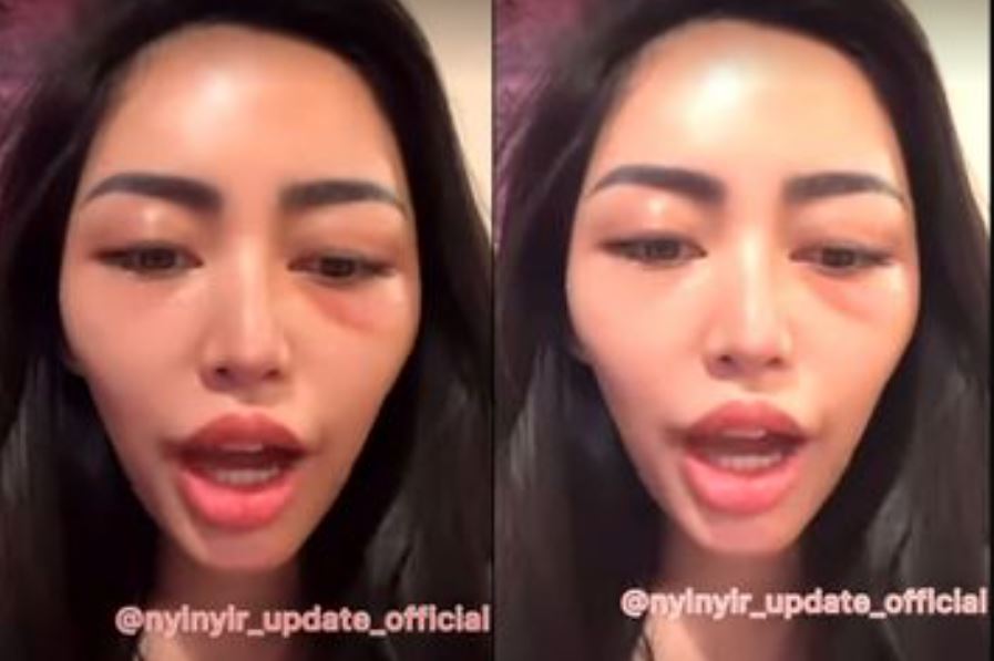 Mata Lebam Rachel Vennya Jadi Sorotan, Kuasa Hukum Buka Suara