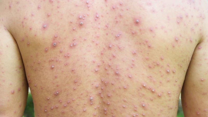 Izin Vaksin Campak untuk Dewasa Keluar, Kemenkes Prioritaskan Vaksinasi bagi Tenaga Kesehatan