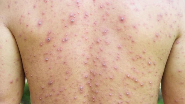 Izin Vaksin Campak untuk Dewasa Keluar, Kemenkes Prioritaskan Vaksinasi bagi Tenaga Kesehatan