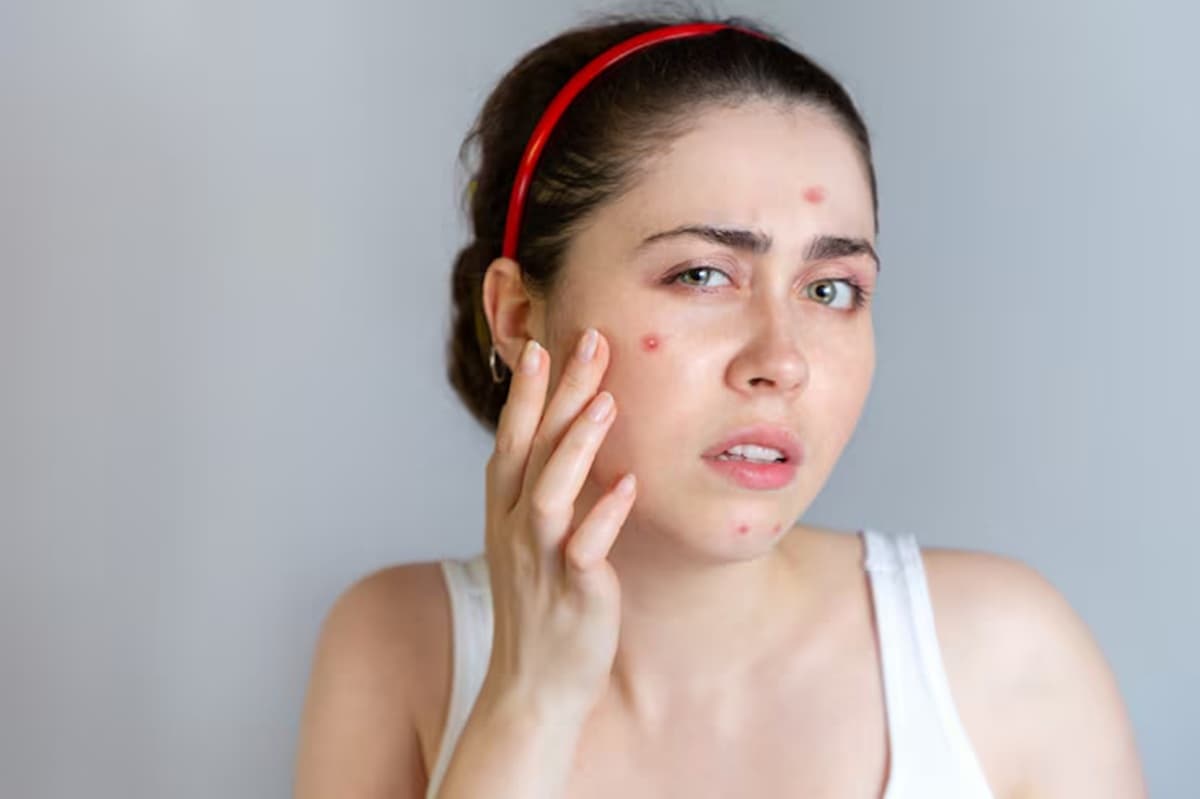 Kulit Rusak karena Skincare Abal-Abal? Ini Langkah Pertolongan Pertamanya