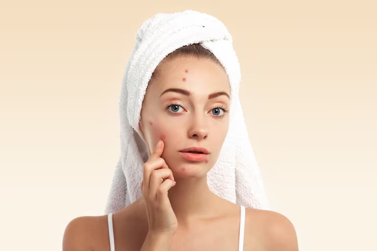 Jangan Salah Paham, Jerawat Setelah Berhenti Pakai Skincare Abal-Abal Ternyata Bukan Detoks