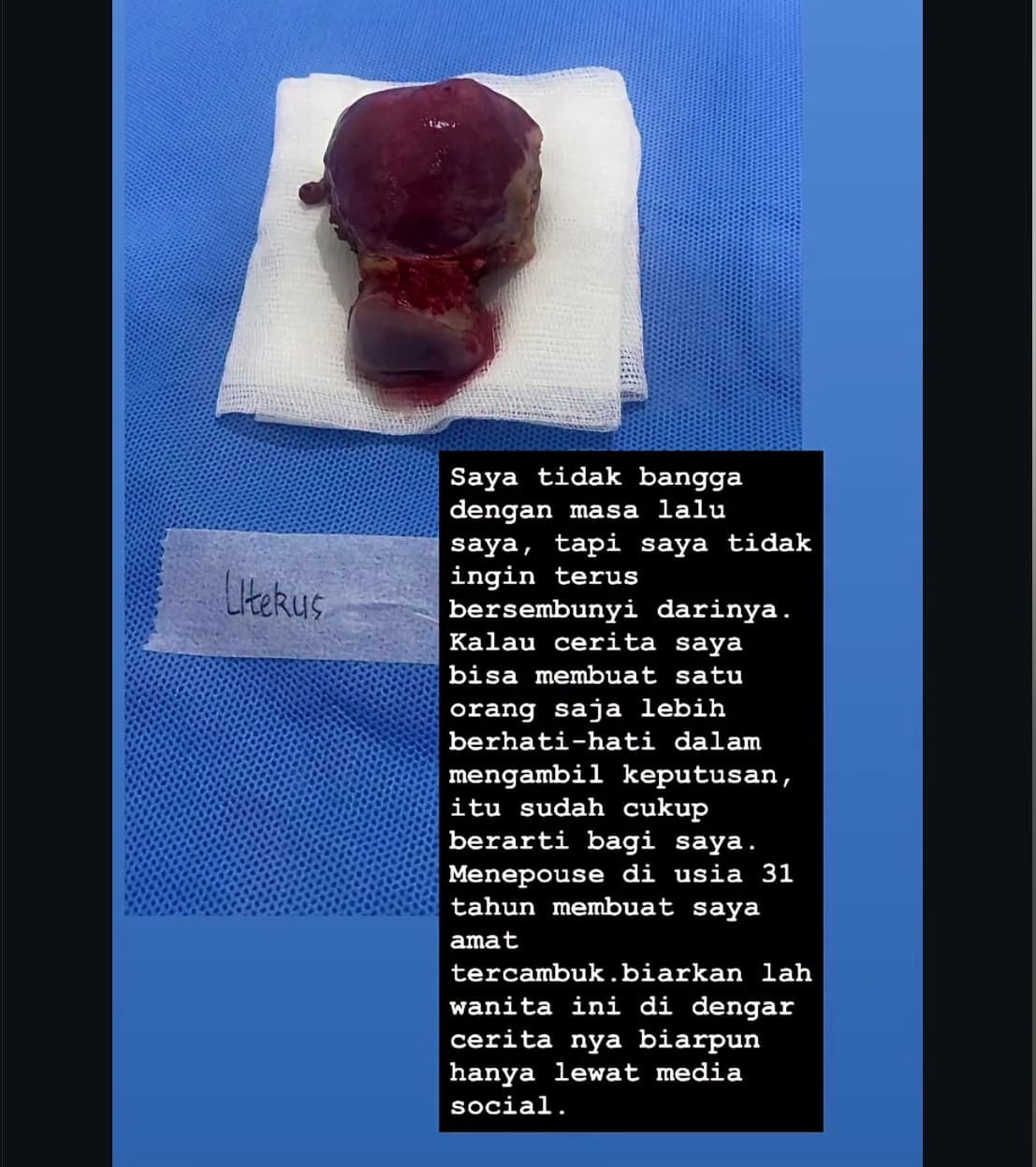 Kisah Ayu Aulia, Mantan Model Majalah Dewasa yang Angkat Rahim karena Aborsi