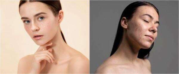 11 Rekomendasi skincare menghilangkan flek hitam & cara menggunakannya